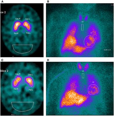 REM-Sleep Behavior Disorder in Patients With Essential Tremor: What Is Its Clinical Significance?